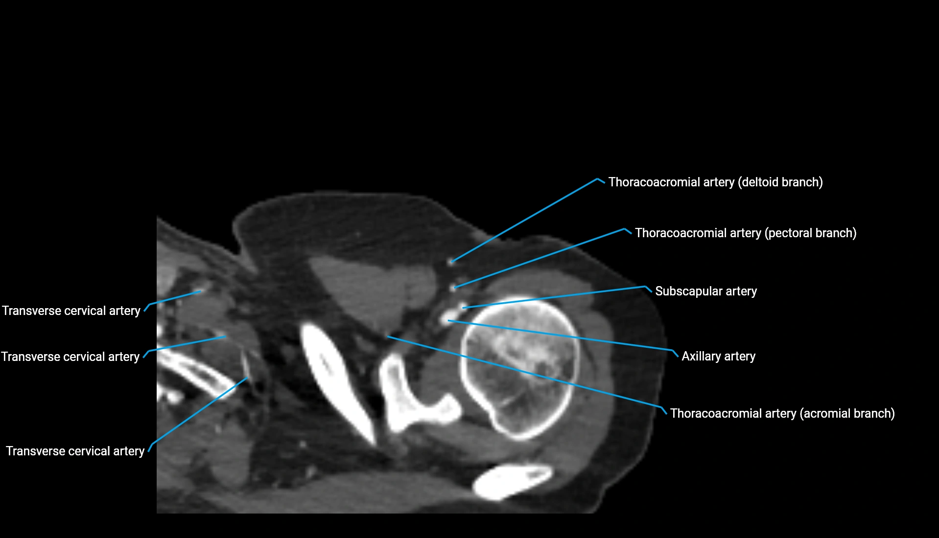 CTA upper limb axial cross sectional anatomy labelled image 325 (1).webp